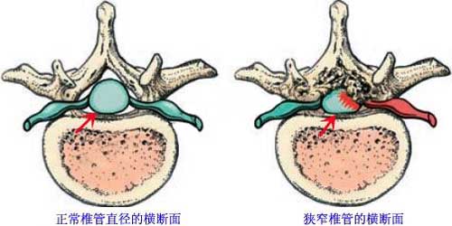 微创治疗腰椎管狭窄效果好吗