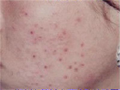 你真的了解痘痘吗,你是真的了解侘寂风吗