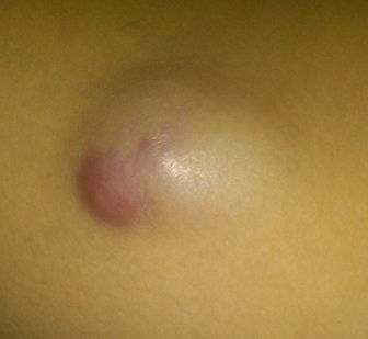 脑袋长疖子的最佳治疗方法,头皮上长了一个火疖子