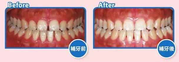 牙缝大的人漏财,牙缝变大有漏财说法吗