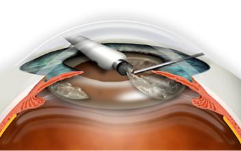 你真的了解老花眼吗,白内障晶体你了解吗