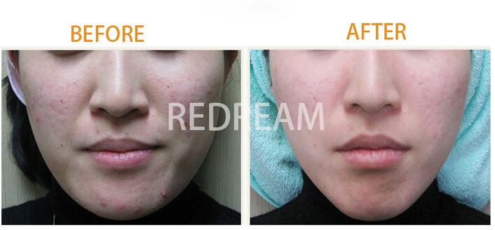 长完痘痘后留下坑坑洼洼怎么办,脸上有坑坑洼洼痘痘怎么修复