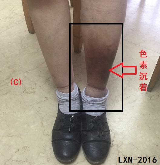 针刺放血疗法能治哪些病,放血疗法治疗腰间盘突出症