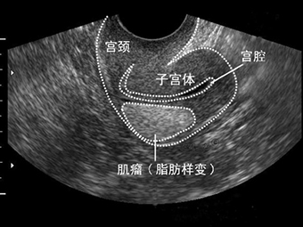 梅艳芳和阿桑，如果再有一次机会我一定会尽早离开“它”