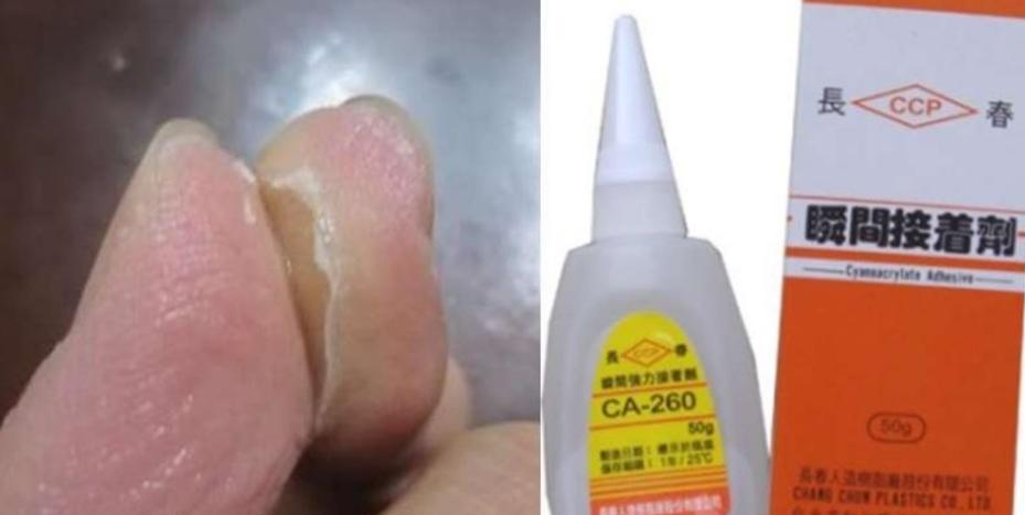 不小心被快干胶黏住手指怎么办？有了这些方法就不用着急了