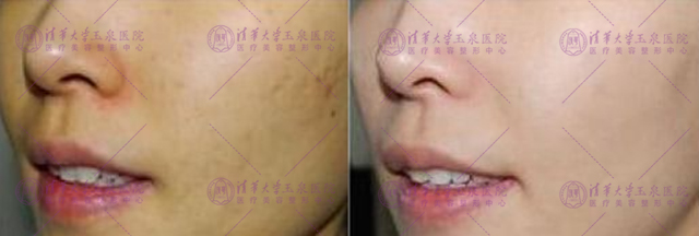 瓷娃娃美白过程,白瓷娃娃美白