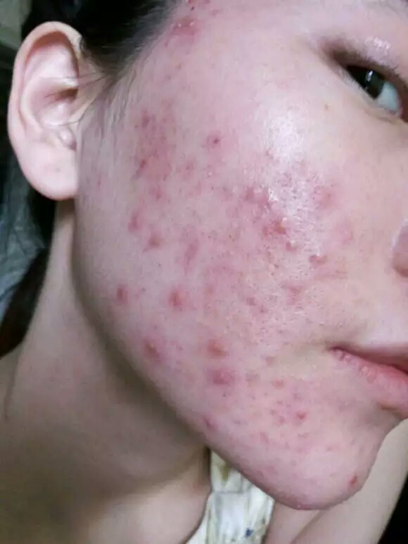 脸上突然起痘痘还泛红痒为什么,月子里脸上起痘痘还痒怎么回事