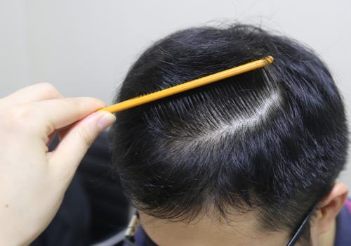 你知道吗？脱发不长，首先要防止脱发毛囊损伤和功能退化