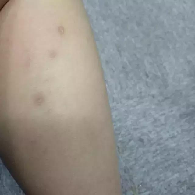 祛疤膏真的去不了增生吗,疤痕三四年了用祛疤膏能淡化吗