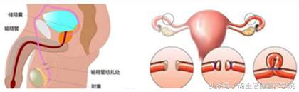 避孕措施只能上环吗,避孕可以采取哪几种措施