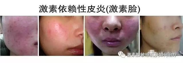 朵嘉浓修护激素脸,朵嘉浓真的可以修复激素脸么