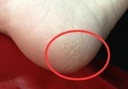 脚干裂怎么办？看中医怎么说？