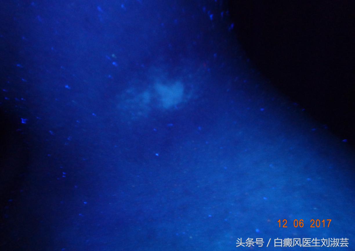 太阳晒后出现白癜风怎么修复,太阳晒伤会得白癜风吗