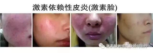 激素脸的症状图片展示,激素脸有哪些症状如何辨认