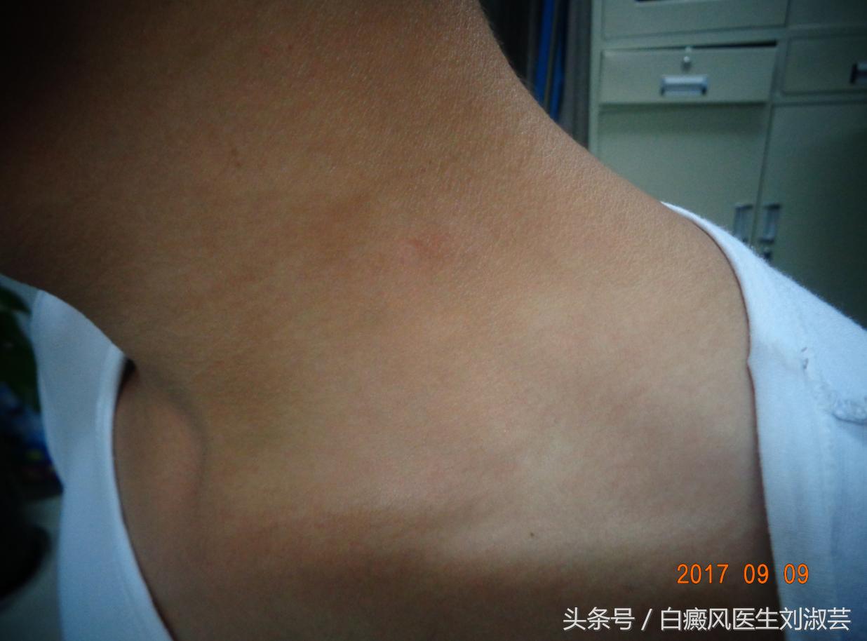 太阳晒后出现白癜风怎么修复,太阳晒伤会得白癜风吗