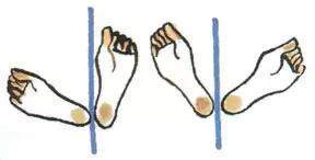 儿童骨盆倾斜长短腿调整方案,骨盆倾斜锻炼方法