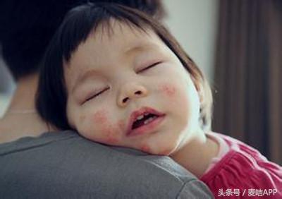宝妈后悔孩子湿疹用激素而不是修复凝胶导致宝宝留黑斑