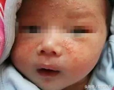 宝宝被湿疹折磨苦不堪言，是因为你没用对方法！