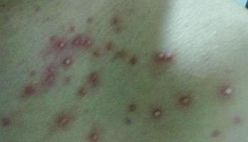 10年湿疹又痒又丑，老医师的一好方子，3周赶走烦人湿疹！