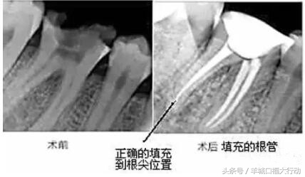 根管治疗的费用为什么差异那么大,根管治疗便宜和贵有什么区别