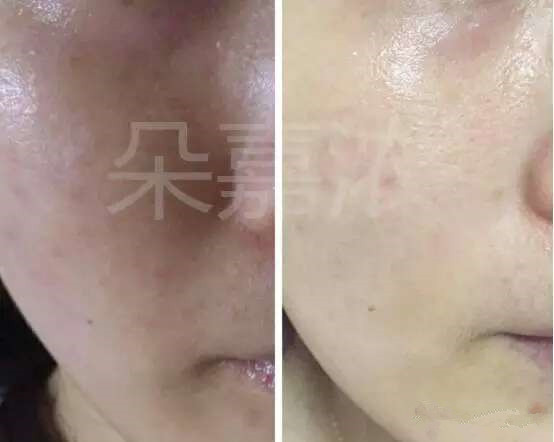 朵嘉浓李顺：油性肌肤如何护理，毛孔粗大长痘，脂溢性皮炎怎么办