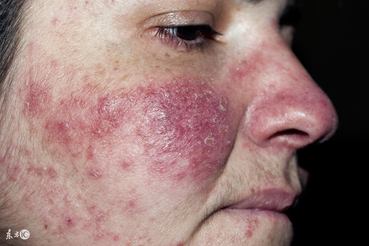 治疗激素脸真的像修仙一样！除了忌口，激素脸治疗还有哪些关注的