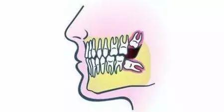 我只有28颗牙齿正常吗,一排只有14颗牙齿正常吗
