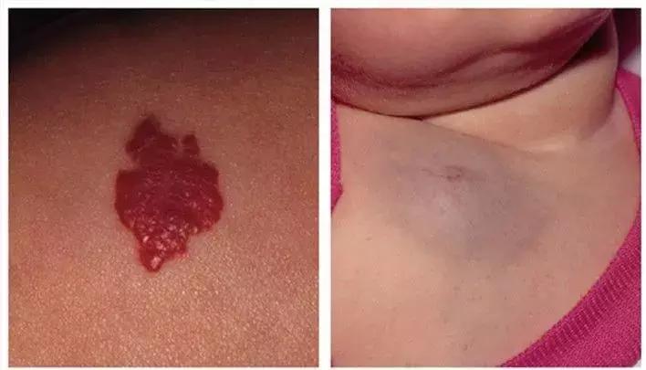 胎记及早治疗,胎记不治有什么后果