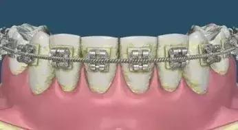 戴牙套托槽松动怎么办,牙套托槽丢了补一个多少钱