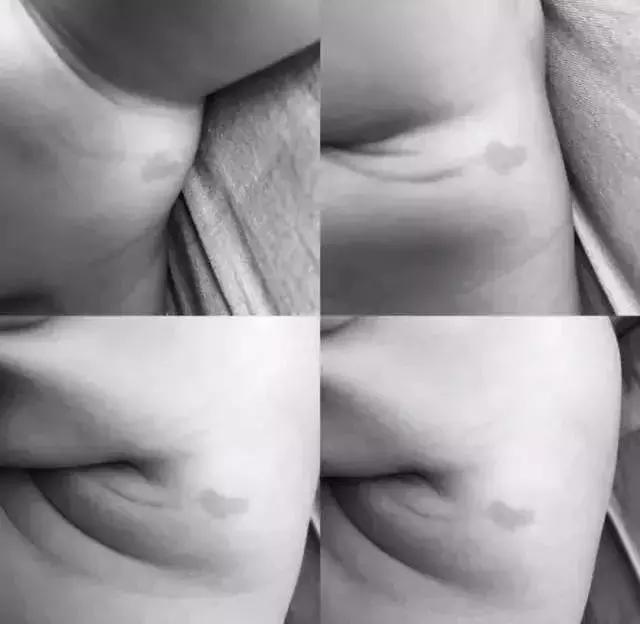 胎记及早治疗,胎记不治有什么后果