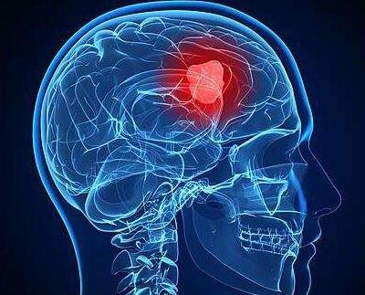 立体定向放射治疗让脑瘤患者生存,放射性粒子植入治疗脑瘤