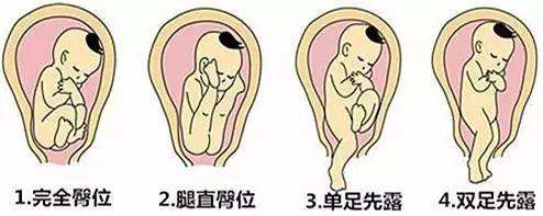 想顺产需要看哪些指数,要想顺产都要做哪些准备工作