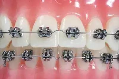 戴牙套托槽松动怎么办,牙套托槽丢了补一个多少钱