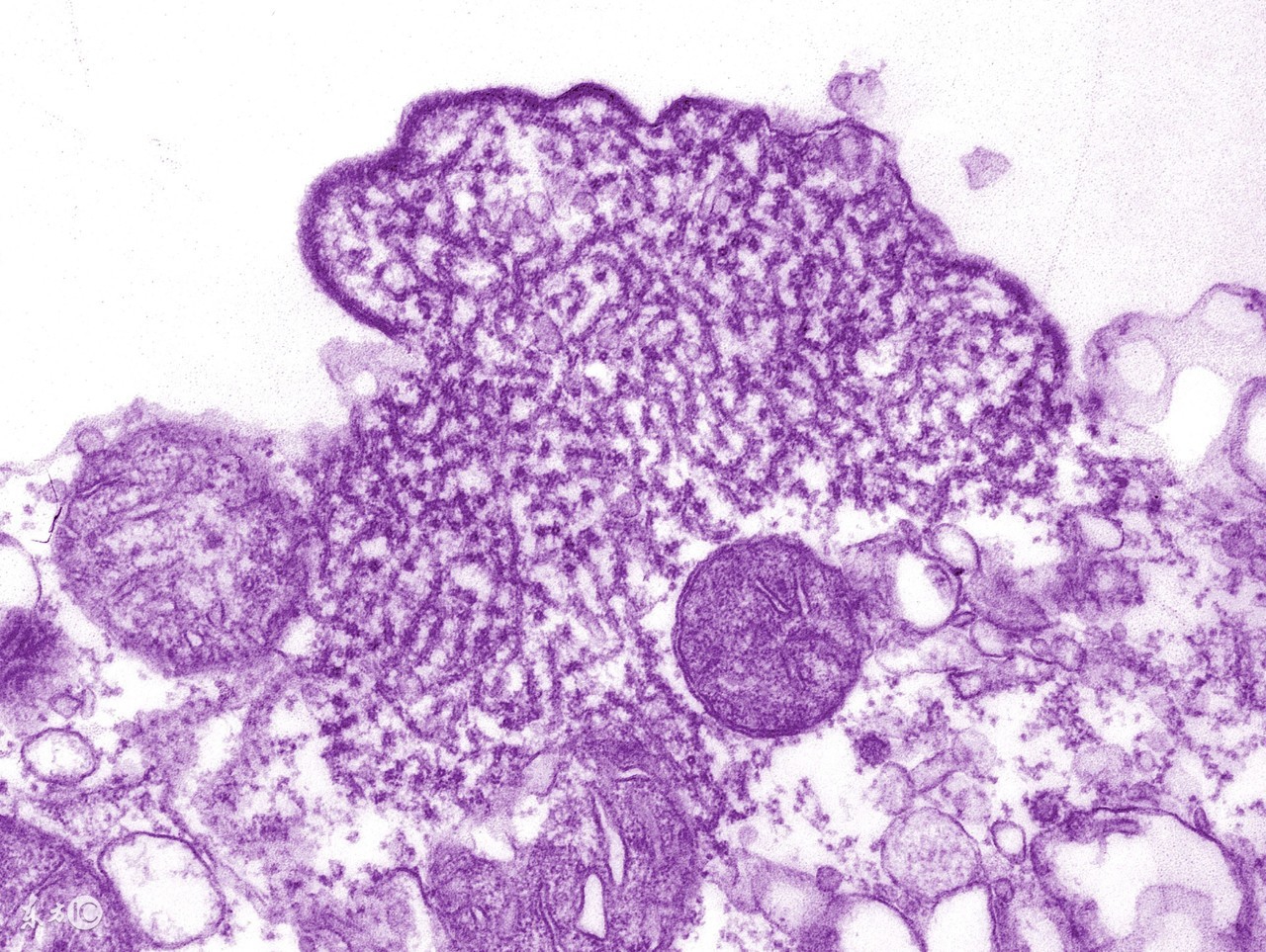 孕期检查巨细胞病毒阳性77.3,孕期感染了巨细胞病毒有什么症状