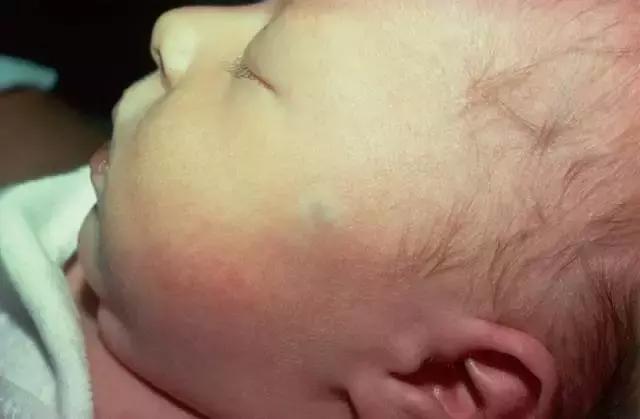 胎记及早治疗,胎记不治有什么后果