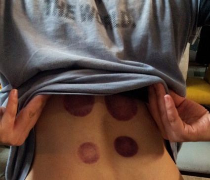 拔罐，是养生还是自虐？｜话题吧