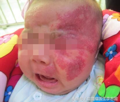 儿童医院做血管瘤激光治疗视频,婴幼儿血管瘤打激光几次能打掉