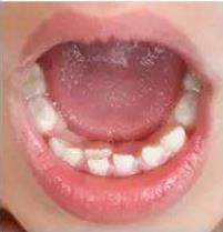 儿童换牙后的乳牙如何处理,儿童换牙期乳牙停留怎么办