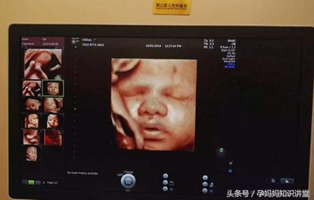 拍四维彩超让关注左肾情况,做四维彩超需要关注什么