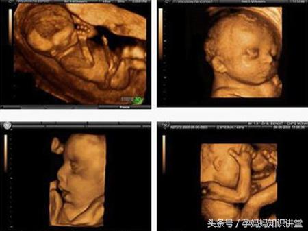 拍四维彩超让关注左肾情况,做四维彩超需要关注什么