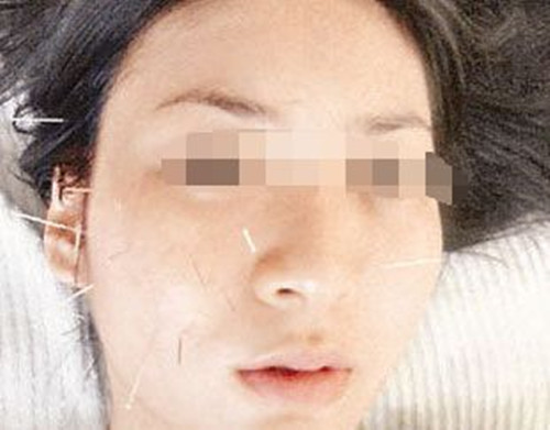 孕期面瘫是突发性还是有什么症状,孕妇孕中期轻微面瘫