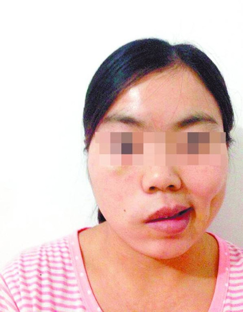 孕期面瘫是突发性还是有什么症状,孕妇孕中期轻微面瘫