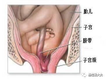 胎儿脐带脱垂能抢救过来吗,脐带脱垂胎儿命悬一线