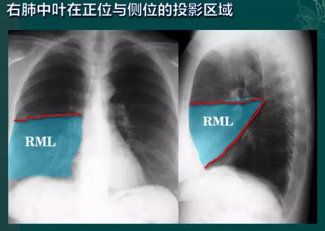 读完该文，让你学会如何看胸片