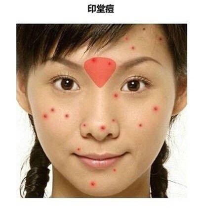 看图识别痘痘,看懂各种痘痘类型和应对方法