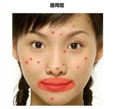 看图识别痘痘,看懂各种痘痘类型和应对方法
