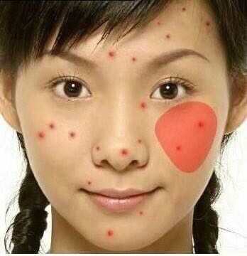 看图识别痘痘,看懂各种痘痘类型和应对方法