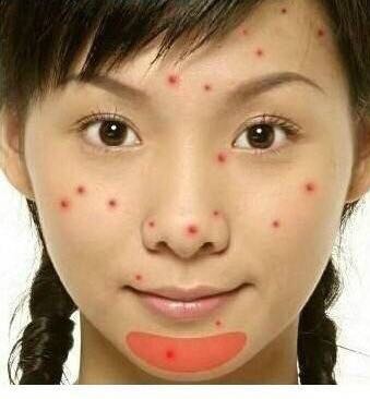 看图识别痘痘,看懂各种痘痘类型和应对方法