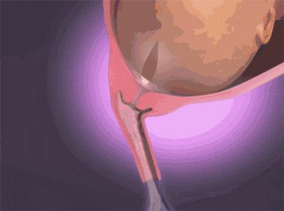 分娩过程简述20字,分娩的全部过程了解