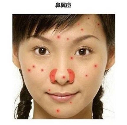 看图识别痘痘,看懂各种痘痘类型和应对方法